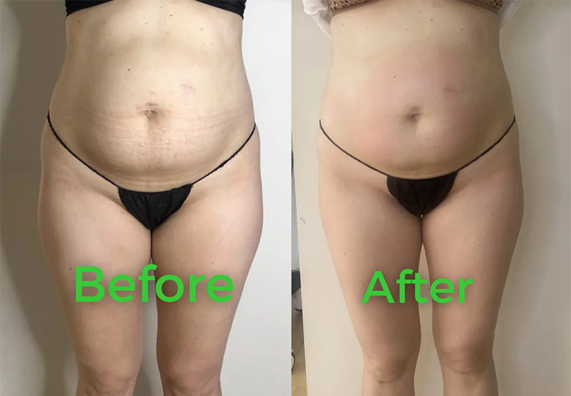 Before and after body contouring result