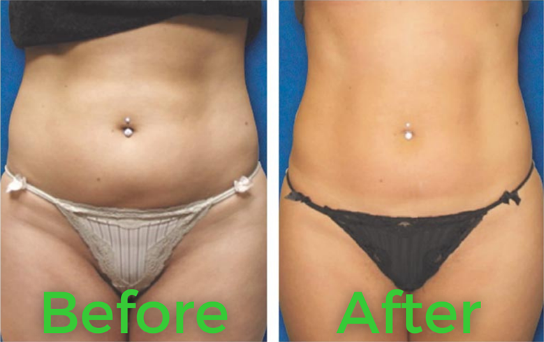 Before and after body contouring result