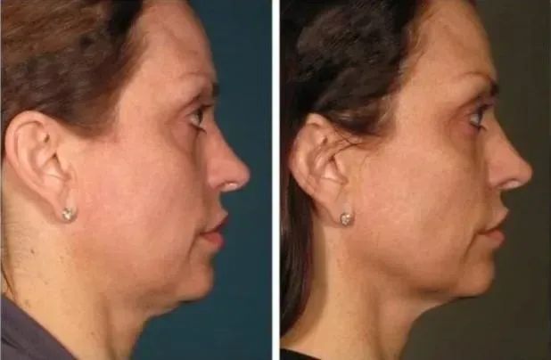 Before and after neck skin tightening result