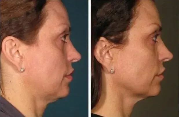 Before and after neck skin tightening result