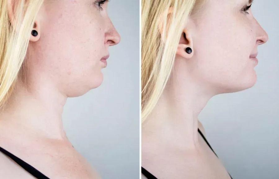 Before and after neck skin tightening result