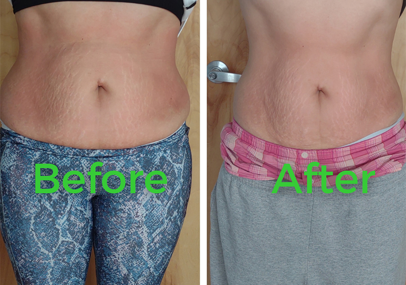 Before and after body contouring result