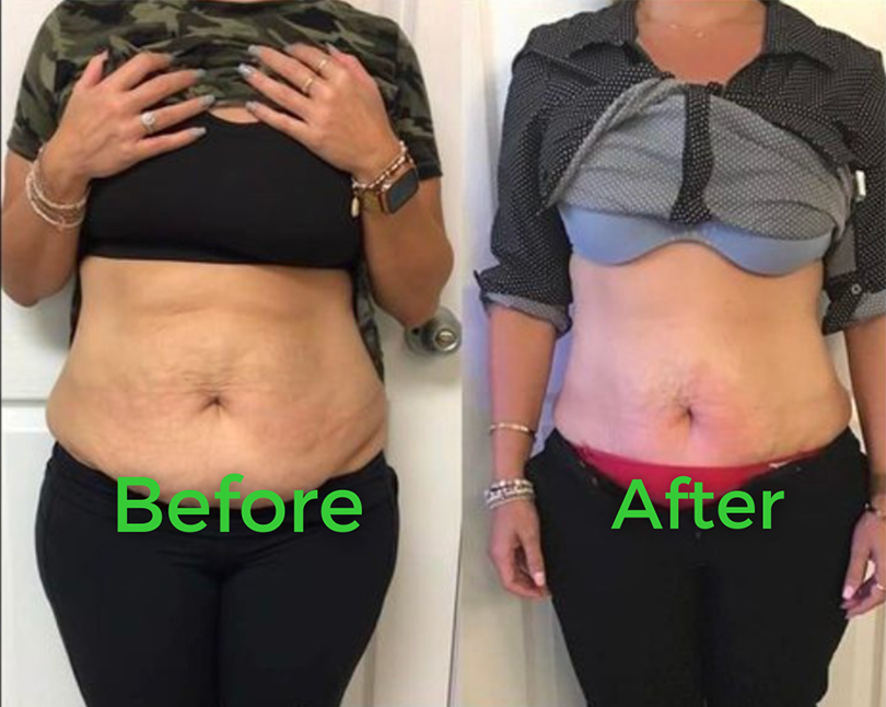 Before and after body contouring result