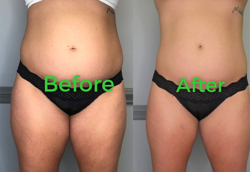 Before and after body contouring result