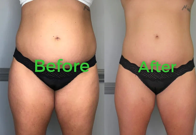 Before and after body contouring result