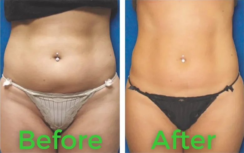 Before and after body contouring result