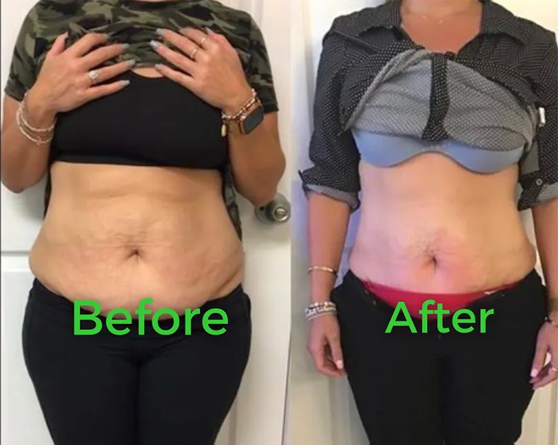 Before and after body contouring result