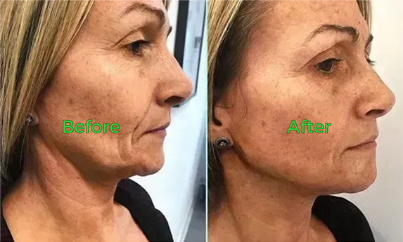 Before and after neck skin tightening result