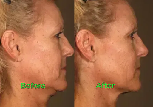 Before and after neck skin tightening result
