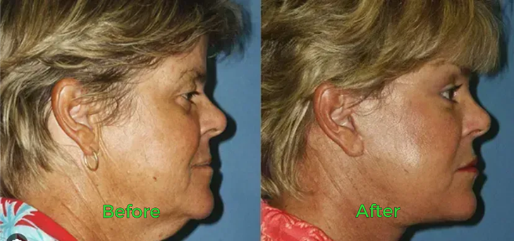 Before and after neck skin tightening result